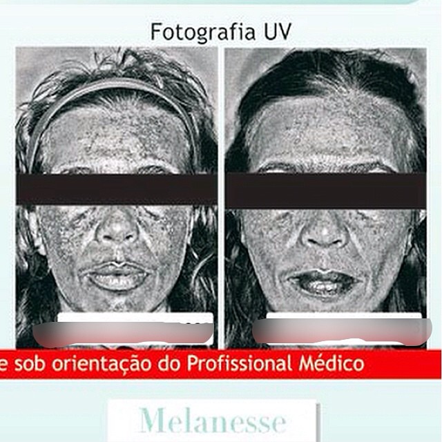 Redução de pigmento na pele visualizado na fotografia UV após uso do peeling melanesse. Juntamente com o tratamento domiciliar, combate manchas, melasmas e melhora o viço da pele!