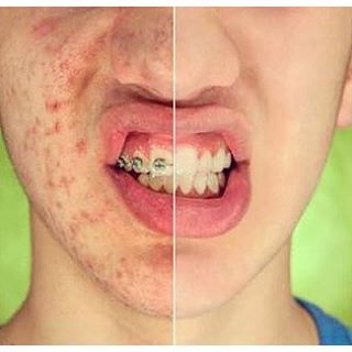 Marca de acne é coisa do passado!Acne. Só o nome já faz tremer muita gente, não é mesmo? As cicatrizes causadas pela acne podem ser profundas, dando um aspecto nada saudável para a pele. E até podem atrapalhar bastante a vida de qualquer um.Aqui na Renewmed, uma opção que indicamos para amenizar ou mesmo tornar a pele afetada pela acne bem lisinha é o tratamento com o laser CO2 fracionado, seguido do Harmony Laser. O CO2 fracionado proporciona um tratamento eficaz para a pele danificada, substituindo-a por uma de aspecto mais rejuvenescido. Por ser fracionado, apenas uma parte da superfície da pele é tratada pelo laser deixando pequenas “ilhas” de pele intacta. Esta técnica faz com que o processo de cicatrização seja muito mais rápido, permitindo o retorno do paciente às suas atividades normais em pouco tempo. Já o Harmony Laser  promove o acabamento necessário após o CO2, proporcionando mais estímulo à formação de colágeno e uma sensível melhoria no clareamento da pele.Se as cicatrizes da acne estão incomodando a sua vida social e até profissional, vale a pena marcar uma consulta aqui na Renewmed com nossos especialistas.