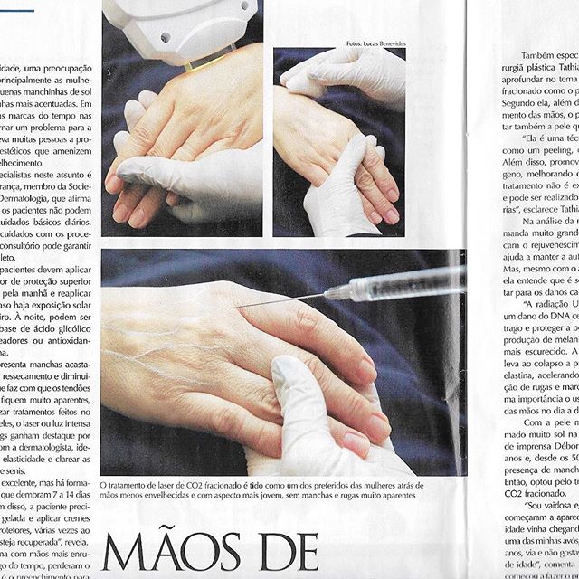 Mais uma matéria que estava devendo e que saiu na #revistaOFlu , dessa vez sobre o #rejuvenescimentodasmãos ! Tratamentos como #luzpulsada #preenchimento com #radiesse #laserco2fracionado e várias outras dicas...#clippingrenewmed #mãosdeprincesa #mãosdefada #renewmed