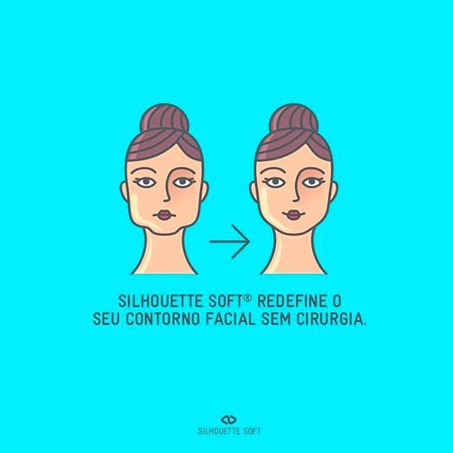 #suturasilhouette redefine o rosto sem cortes e sem pontos! Esse fio de ácido polilático, faz sustentação das áreas afetadas pela #flacidez , e estimula o #colageno durante o tratamento.É completamente #reabsorvível e Sua aplicação é simples! Em maio teremos #silhouetteday da #Sinclair !!#efeitolifting #liftingfacial #renewmed #rejuvenescimentofacial