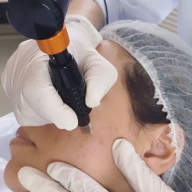 Vem entender como funciona o NanoPore ou MMP facial!