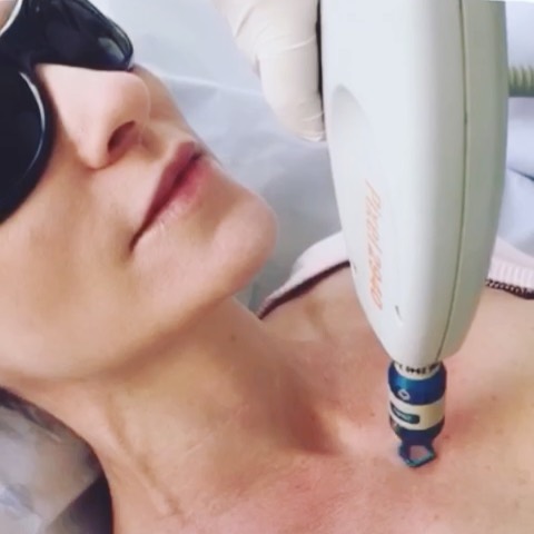 Uma das ponteiras do Harmony XL é a ponteira Pixel de erbium laser. Com ela é possível fazer um rejuvenescimento de face, colo e pescoço, de forma indolor e com uma recuperação muito rápida, sendo o pós apenas de uma pequena vermelhidão. Ela praticamente não descama e ainda estimula o colágeno. 🏻