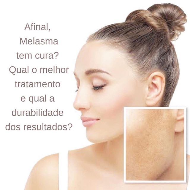 Durante toda a semana passada recebi perguntas no DM sobre melasma e sobre tratamentos à laser para o melasma.
Não sei se o assunto esteve à tona no momento, mas elucidar algumas questões sobre melasma, sempre é bom!

Uma das questões mais recebidas é sobre a cura do melasma. Eu sempre gosto de rebater falando em “CONTROLE” do melasma… Sim, muitas vezes a melhora advinda de um tratamento é apenas uma forma de controle da hiperpigmentação.

E falando nisso, a melhor medida associada ao tratamento, ainda é a fotoproteção! O uso regular do protetor solar, diariamente e com as reaplicações necessárias, é indispensável para manter a pele sem manchas! Algumas características devem ser levadas em conta: dê preferência aos protetores com cor, por causa da proteção contra a luz visível, e com uma alta cobertura de preferência. Uma boa dica é nós horários de reaplicação, reforçar com protetor solar em pó!

Os tratamentos com ácidos despigmentantes ainda tem bastante efetividade, e podem ser associados a peelings e Microagulhamentos. A resposta aos diferentes ativos é muito pessoal e por isso a resposta pode variar.

O uso de lasers ablativos como CO2 não é o ideal, a menos que haja outra lesão que justifique (como cicatrizes de acne), nesse caso tratamos as cicatrizes para depois continuar o tratamento do melasma.
Os lasers mais indicados são os de baixa energia e pico-segundos. Também com respostas variadas entre os pacientes.

Uso de antioxidantes tópicos e orais vem se mostrando ótimos coadjuvantes, assim como tratamentos que bioestimulem colágeno, pela ativação dos fibroblastos.

Os melasmas não são todos iguais. Eles podem ser dérmicos, epidérmicos ou mistos. E esse é outro fator que diferencia a resposta aos tratamentos.

Conseguiu uma boa resposta ao tratamento? Então continue protegendo e cuidando da pele como no início. Pois a exposição solar sem proteção, exposição ao calor, hormônios e etc, também podem desencadear a hiperpigmentação novamente!
.
.
#melasma #dermatologia #dermalovers