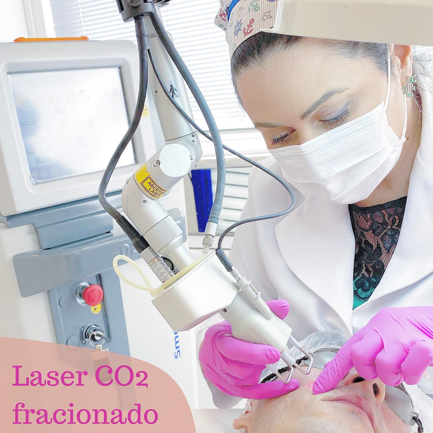 Frente fria entrou e a gente pensa logo em CO2 fracionado!!!Apesar de ter um pós procedimento com edema, vermelhidão e muitas casquinhas, ele é um dos queridos da estação!Rejuvenesce, estimula colágeno, efeito tightening (Lifting), efeito peeling... tudo num só!Meu aparelho também tem a opção de radiofrequencia associada, garantindo ainda maior produção de colágeno para áreas flácidas.Agora também contamos com o fredo, um aparelho de resfriamento para maior alívio durante a sessão.Aproveito sempre também para fazer um drug delivery de substâncias adequadas ao tratamento de cada pele, como clareadores e antioxidantes. A outra novidade são os skin savers da USK, que vão entrar justamente nessa hora do drug delivery!!O que era bom, vai ficar ainda melhor!!!