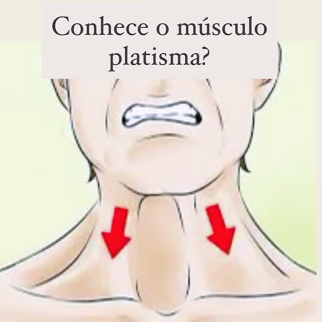 O platisma é um músculo plano e superficial do pescoço.É considerado parte da musculatura da mímica facial. Ele se estende da pele da face desde a mandíbula até aproximadamente a altura da segunda costela. Ele cobre completamente ambos os lados da face anterior do pescoço.  Com o envelhecimento, ele fica mais visível, podendo estar dividido em duas linhas longitudinais na frente do pescoço.Mas o fato é que ao longo de toda a vida, ele exerce uma força puxando a face para baixo e com o tempo ele também pode ser responsável pela perda do contorno facial.Não é uma indicação para todas as pessoas, mas muitas podem se beneficiar da aplicação de botox em pontos estratégicos do platisma para recuperarem o desenho harmonioso do contorno da face!Você já testou o seu?É só fazer uma força mordendo os dentes lá de trás e forçando o lábio para baixo. Assim você descobre a força que o seu platisma exerce e se ele “deforma” seu contorno facial!