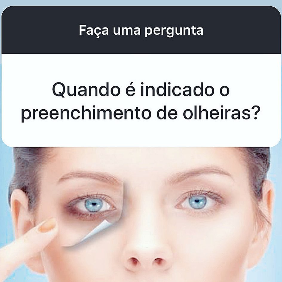 O preenchimento de olheiras é indicado sempre que houver uma profundidade “verdadeira” na região da pálpebra inferior.Muitas pessoas tem apenas uma hiperpigmentação (essa área é escura), e isso faz com que o local acumule uma sombra que faz parecer que é profunda, e nem sempre é! Nesse caso tratamos somente a hiperpigmentação com laser ou ácidos.Tem pessoas que tem uma perda de colágeno e desestruturação da região malar, e com isso também parece que a olheira está mais profunda. Nesses casos também usamos preenchimentos, porém na região logo abaixo das olheiras.Pacientes que tem bolsas de gordura mais proeminentes, podem se beneficiar de um volume mínimo de preenchedor logo abaixo das bolsas, mas são casos que tem que ser muito bem avaliados e excluindo a indicação já cirúrgica... pois o ácido hialurônico é hidrofílico e ao tentar uma correção como essa, o aspecto pode ficar mais inchado ainda.O injetor deve ser habilidoso e nunca colocar uma quantidade grande nessa região de uma única vez.