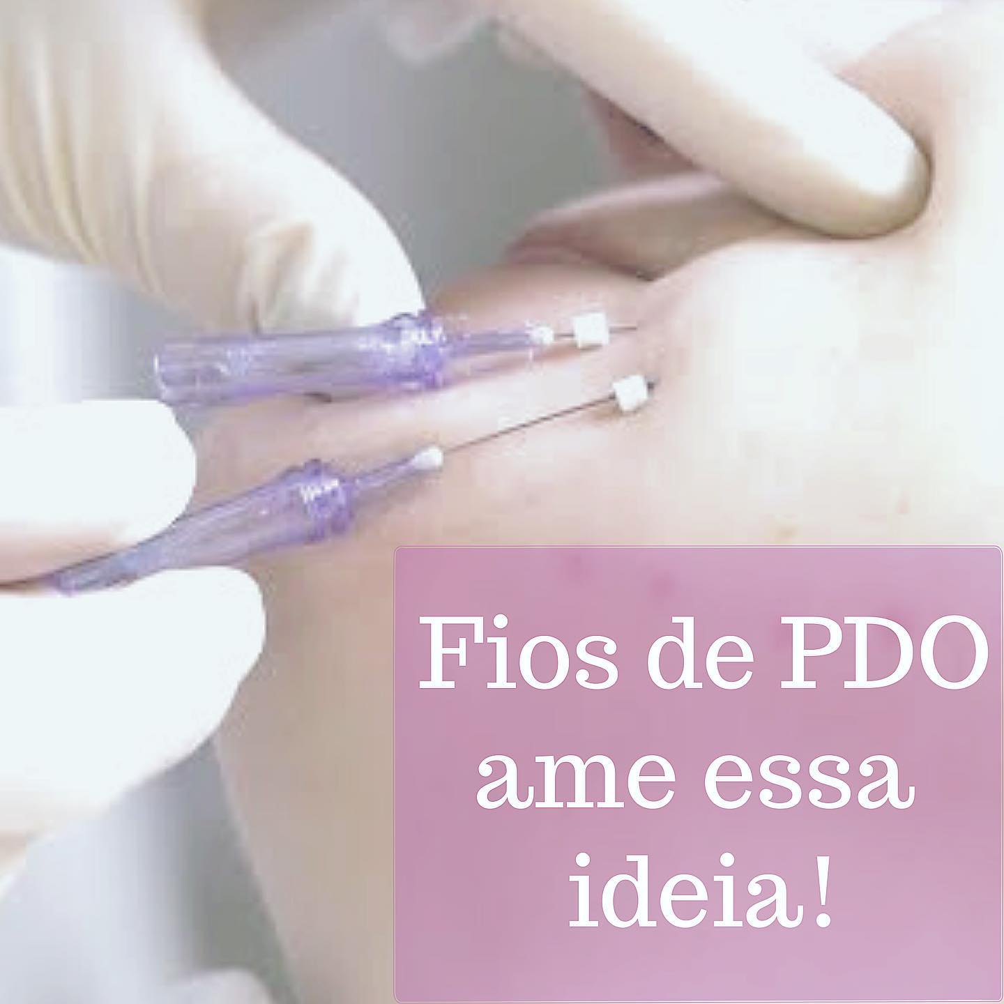 Há anos eles vem ganhando espaço no mercado brasileiro. Febre na Ásia, os fios de PDO fazem estímulo de colágeno e promovem um efeito lifting, além de trazerem um super viço para a pele.Podem ser usados no rosto, pescoço e várias áreas corporais!Eu já usei e amo os resultados! E você, já ouviu falar dos benefícios dos fios?Agenda conosco e vem saber mais!Tem mais sobre eles nos stories e nos destaques também!