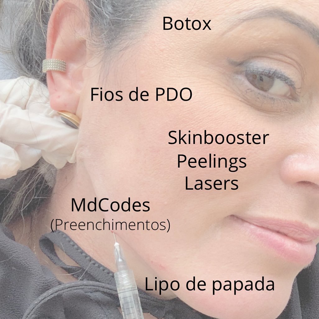 A lista dos aprovados: 🏻😬De 2005 a 2020.Toxina botulínica - 2 a 3x por ano Laser CO2 - anual ou a cada 2a. InvernoLaser harmony - quando não faço CO2Peeling - anual quando acaba o verão Preenchimento - anual (primeiro md Codes 2017)(Primeiro lábio 2020)Skinbooster - só fiz 1!Lipo de papada - 1x (2007)Fio de PDO - 1x (2018)Próximos: ultrassom microfocado, sculptra!Assim começou a minha vida de cuidados, não é uma regra! Cada pessoa tem a sua necessidade...