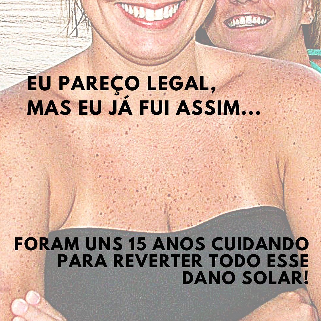 Se você tem mais de 40 anos e gosta de praia e piscina, provavelmente já agrediu sua pele desse jeito!Eu continuo gostando e frequentando, além de fazer esporte ao ar livre, porém nesses últimos anos, com proteção adequada e sempre à sombra em quase todo o tempo.O bronzeado, na verdade, é uma forma de reação do organismo tentando se defender da radiação ultra-violeta.A radiação causa danos ao nosso DNA celular. Como resposta a esse dano, a pele estimula a tirosina, que por sua vez incentiva a produção da melanina , que dá a coloração escurecida à pele.Com isso teremos envelhecimento precoce, marcas, rugas, flacidez indesejada e até mesmo câncer de pele. Ou seja, não existe bronzeado de sol “saudável”! Porém você até pode recorrer aos auto-bronzeadores que dão uma corzinha sem o dano UV.Nunca frequente câmaras de bronzeamento, elas são inclusive proibidas!!Para tratar a pele, recorri aos ácidos, muita hidratação, luz pulsada e lasers.Sem contar que a “marquinha” anda totalmente fora de moda há tempos né!