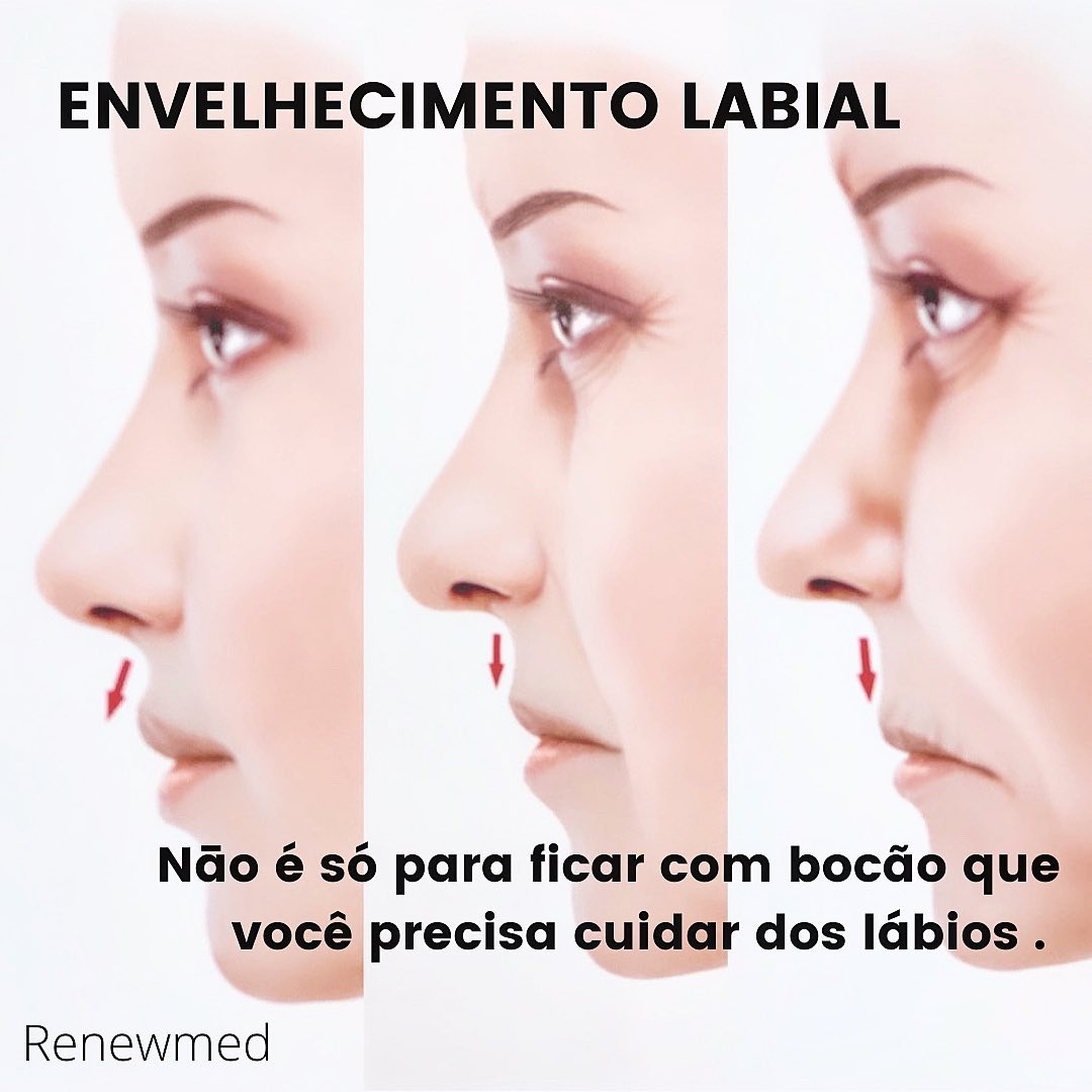 Assim como outras estruturas anatômicas e e outras partes do corpo e da face, nossos lábios também sofrem com o envelhecimento.Além de afinarem, eles perdem projeção e a distância entre o nariz e o lábio superior também aumenta. Em muitas pessoas, ainda é possível ver o aparecimento de linhas de expressão e rugas conhecidas como códigos de barras, assim como queda das comissuras (os cantinhos)...Então temos que ter uma atenção especial para os lábios sim! Eles dizem muito sobre você.Além de preenchedores, também podemos usar toxina e fios.Cada vez mais aprimoradas, agora a técnica do momento chama-se Kyssability Techinique...Você ainda tem medo de mexer nos lábios?