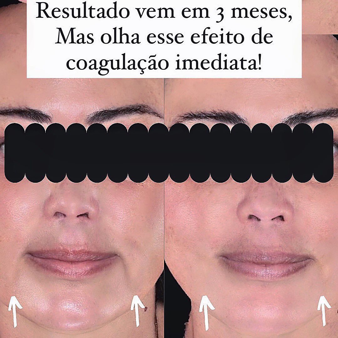 Aproveitando que hoje tem ulthera por aqui, vim explicar com essa foto minha, como ele age!Ele é um aparelho de ultrassom microfocado para efeito Lifting. O ultrassom, ultrapassa a pele de forma convergente e vai criar vários pontos de coagulação no tecido profundo, fazendo literalmente com que ele “encolha”.É como colocar um bife numa frigideira quente!Só que esse dano ocorre somente lá dentro, atingindo o smas (sistema músculo aponeurótico), depois a gordura, e por último estimulando colágeno da derme. Por isso são usadas duas ou três ponteiras que atuam em profundidades diferentes, e pir isso já conseguimos perceber também uma melhora imediata, embora os resultados do calor, ativem nossas células chamadas fibroblastos a produzirem colágeno. Observaremos essa segunda parte de melhora ao longo dos próximos meses após a aplicação...#ulthera #ultherapy #ultraformer #ultraformer3 #lifting #ipanema